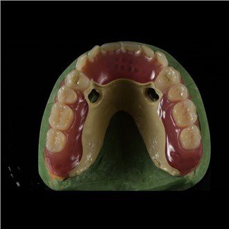 Peek Framework Proteză