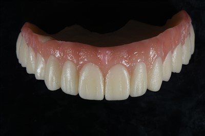 Coroana temporara din rasina acrilica